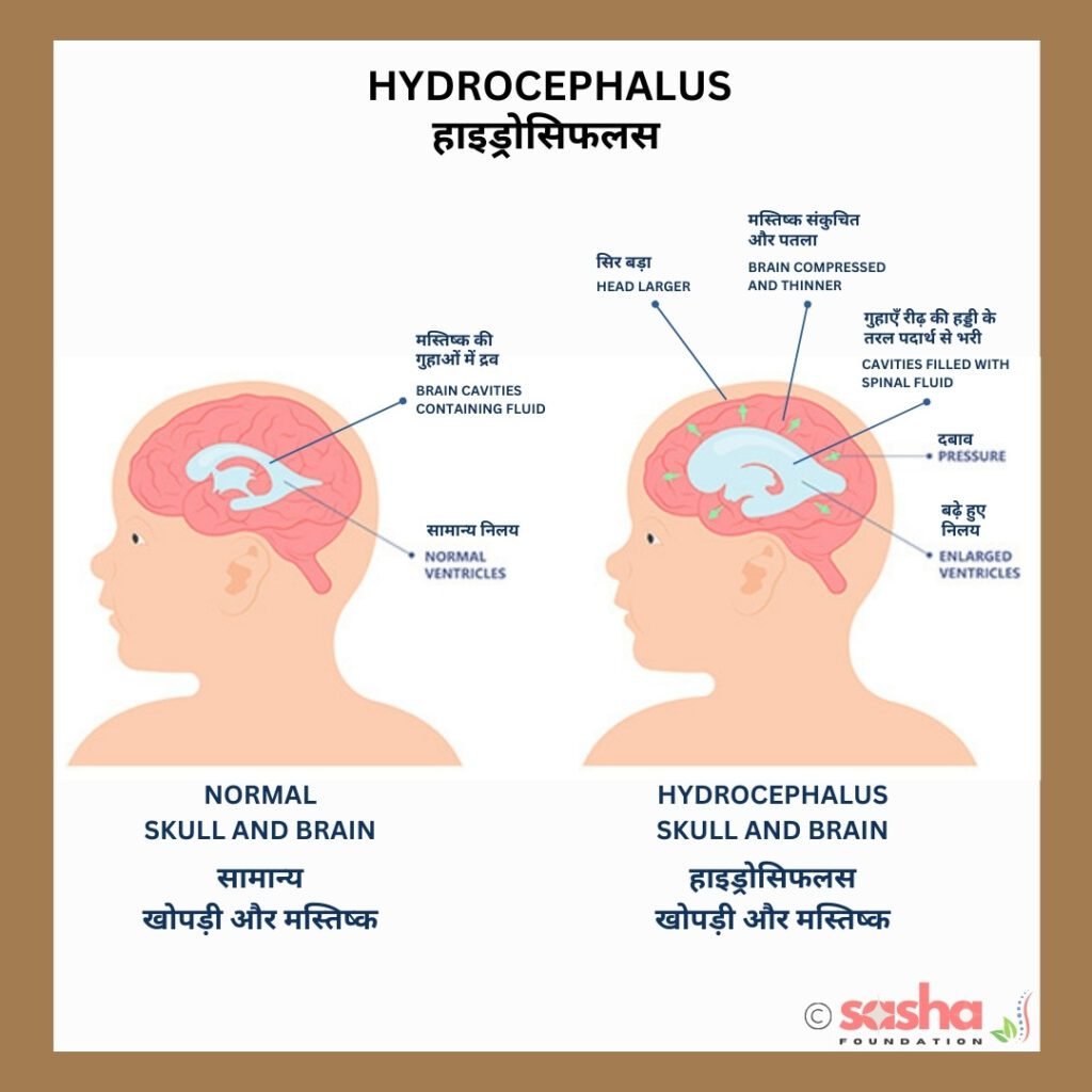 a diagram showing normal brain and a brain with Hydrocephalus