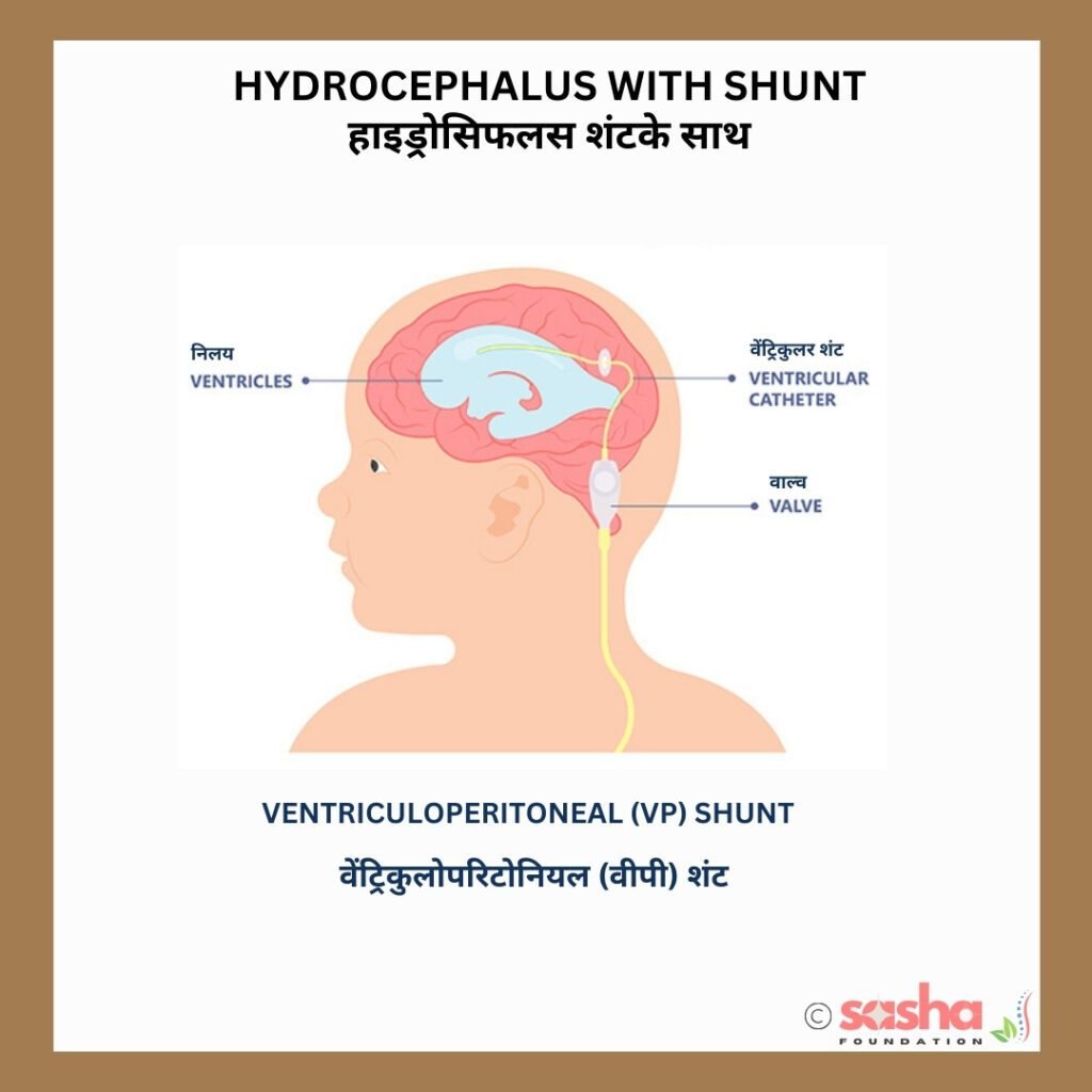a diagram showing Hydrocephalus with a shunt