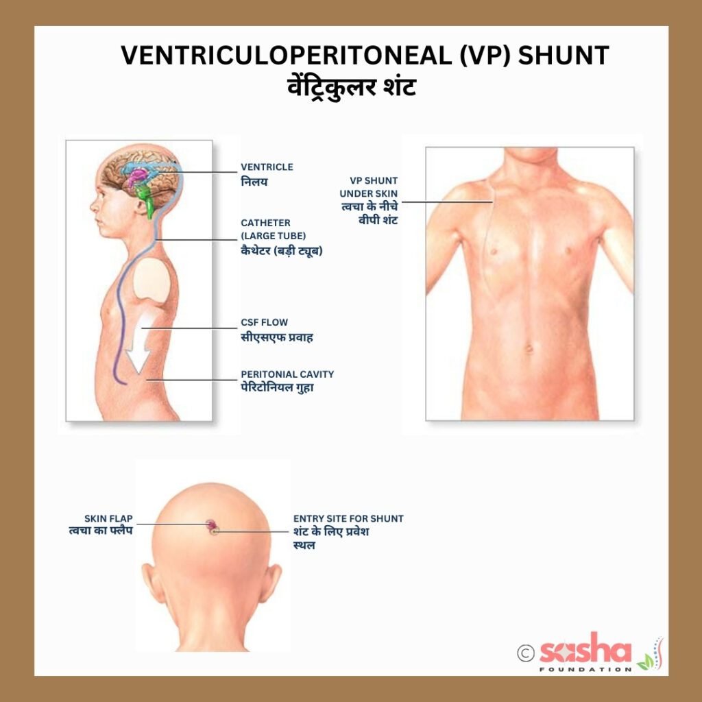 a diagram showing 3 steps of shunt insertion