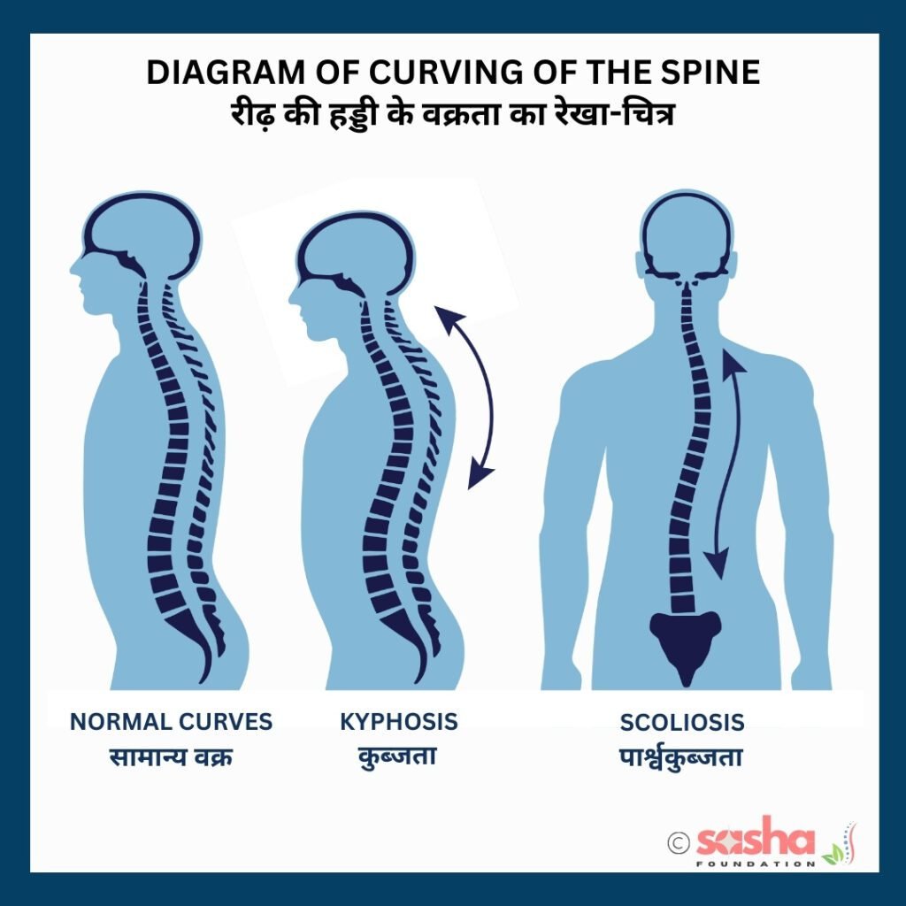 an illustration showing various ways of curving of spine caused by chiari malformation