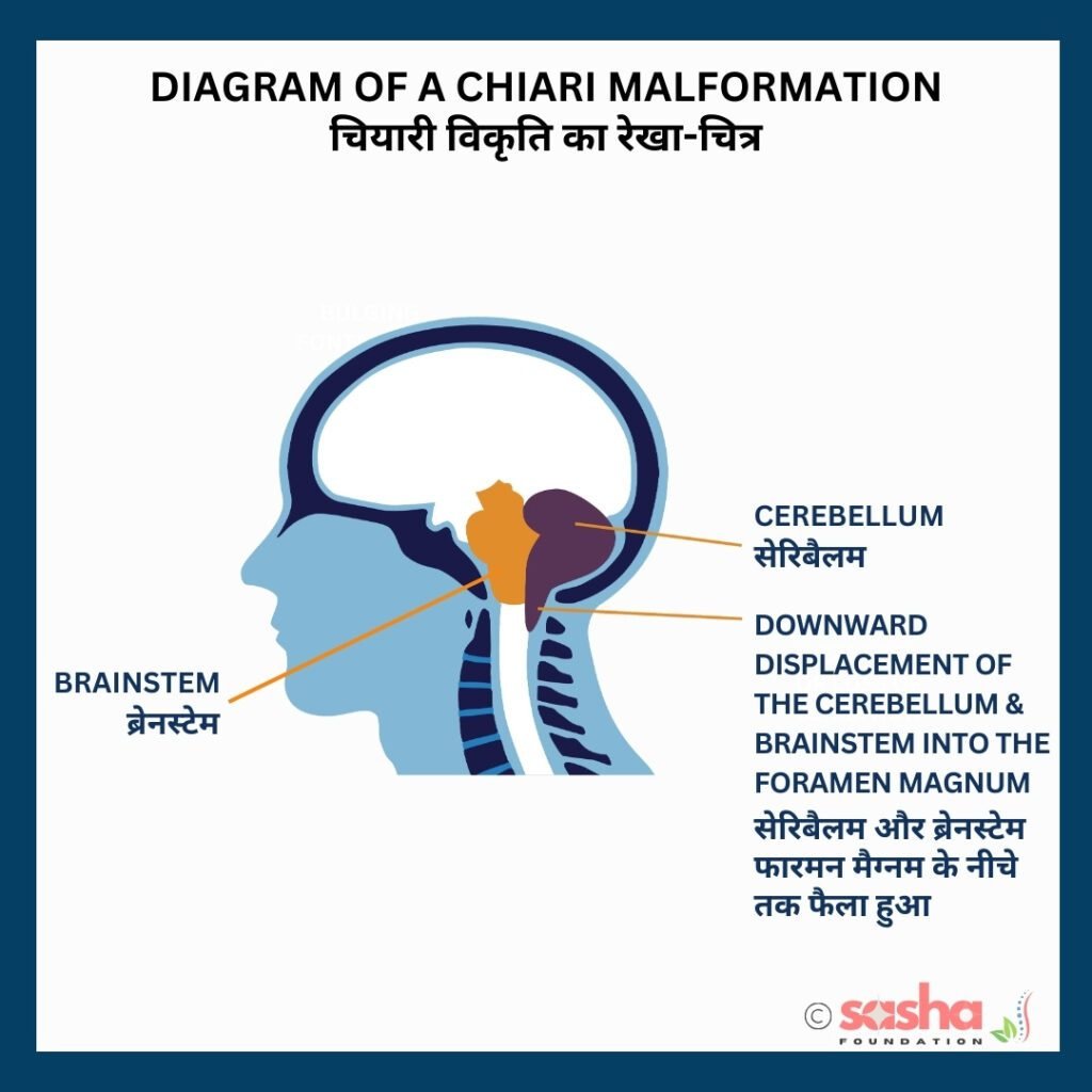an illustration showing chiari malformation type II
