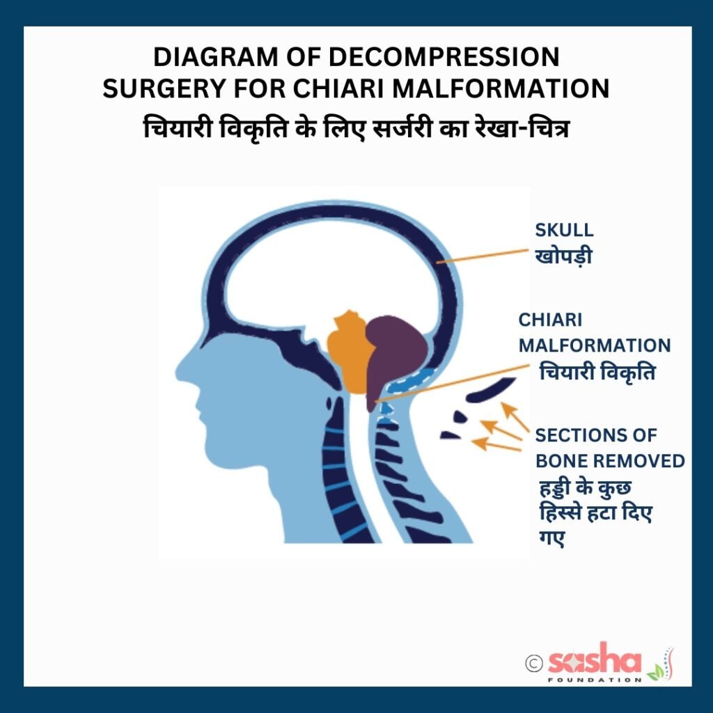 an illustration showing chiari malformation decompression surgery