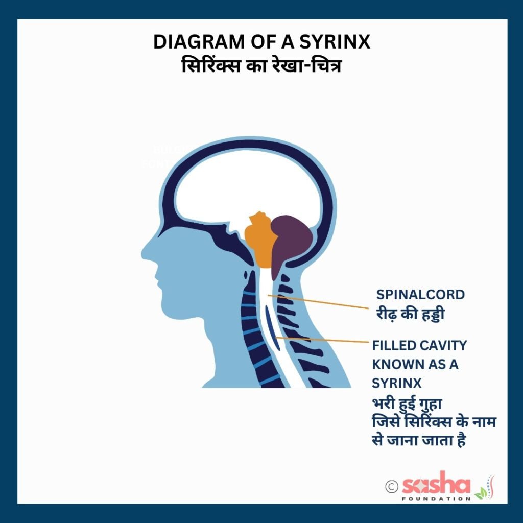 an illustration showing syrinx caused by chiari malformation