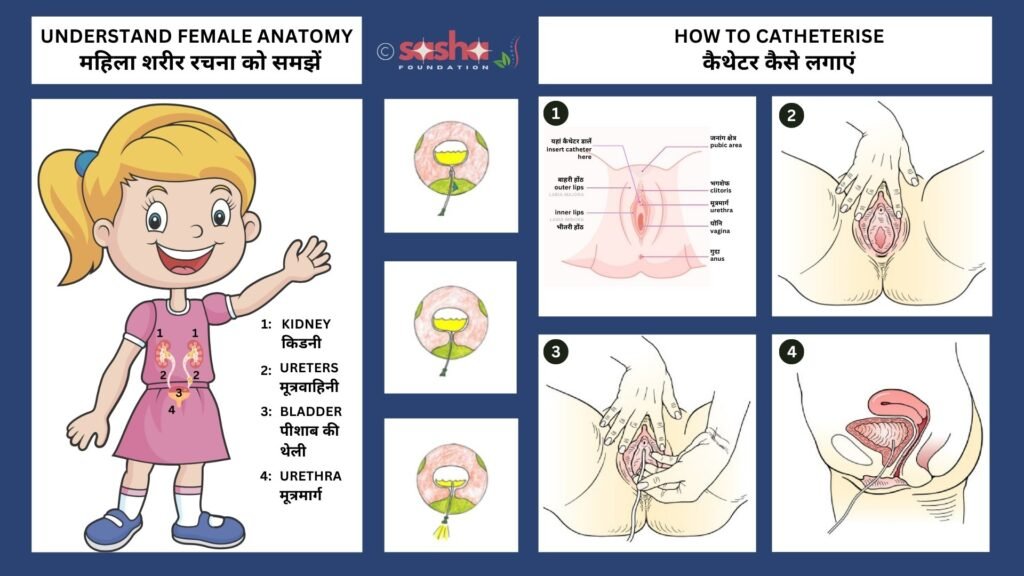 an illustration image showing catheterising steps for female child
