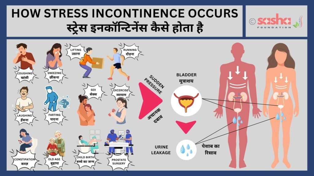 How stress incontinence occurs How stress incontinence occurs, a type of Urinary incontinence