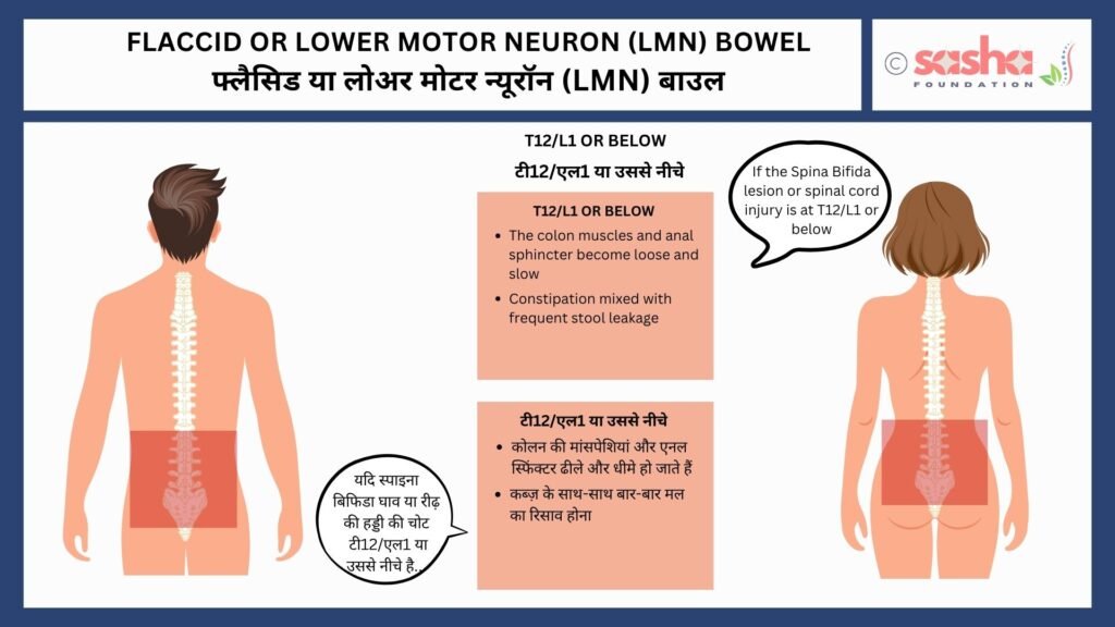 Flaccid or LMN Bowel T12/L1 of below will result in flaccid or LMN bowel