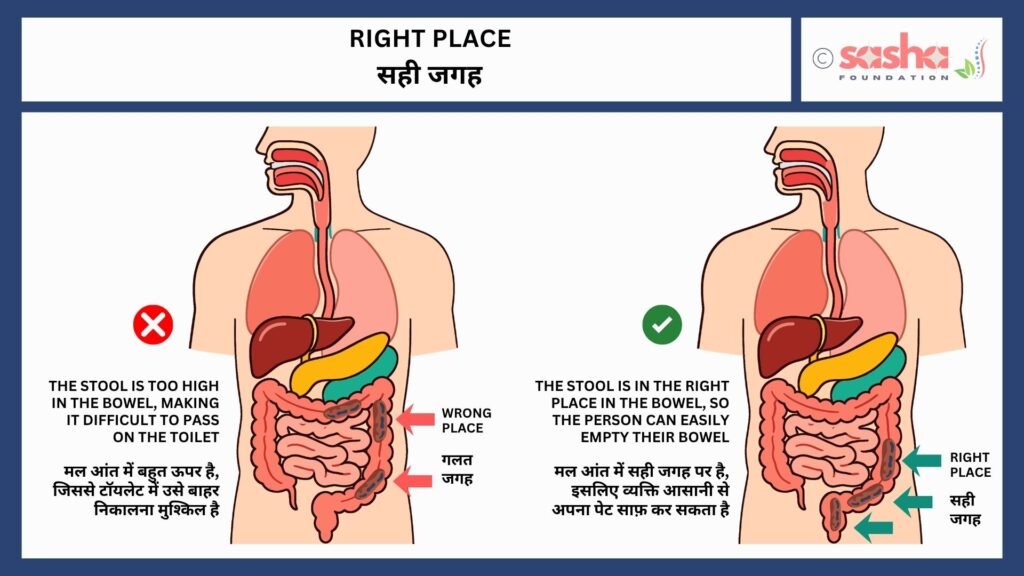 Good Bowel Routine - Right Place Good Bowel Routine's one of the 5 rights - Right place. Right place will help in proper digital evacuation