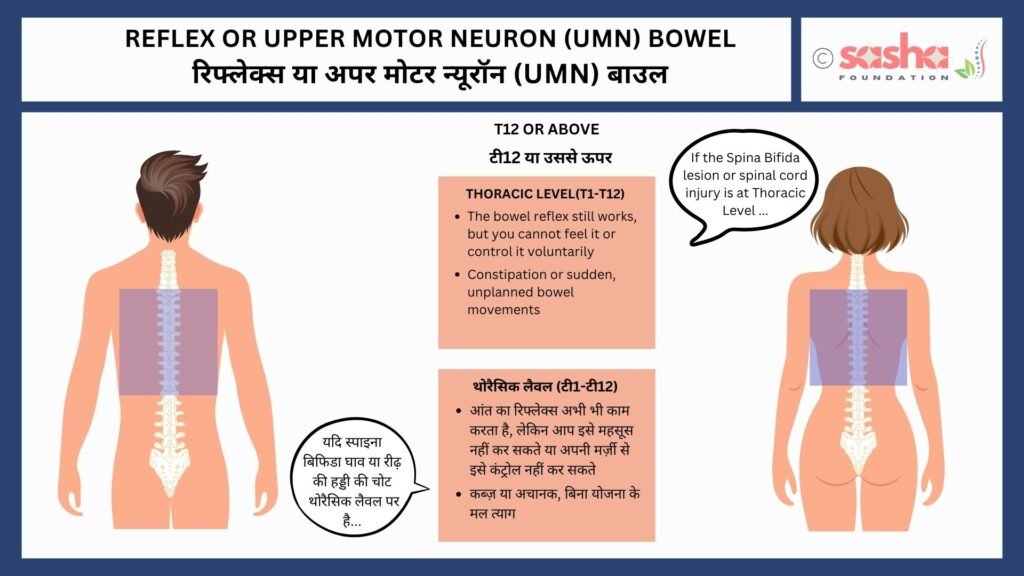 Reflex or UMN Bowel T12 or above will result in reflex or UMN bowel